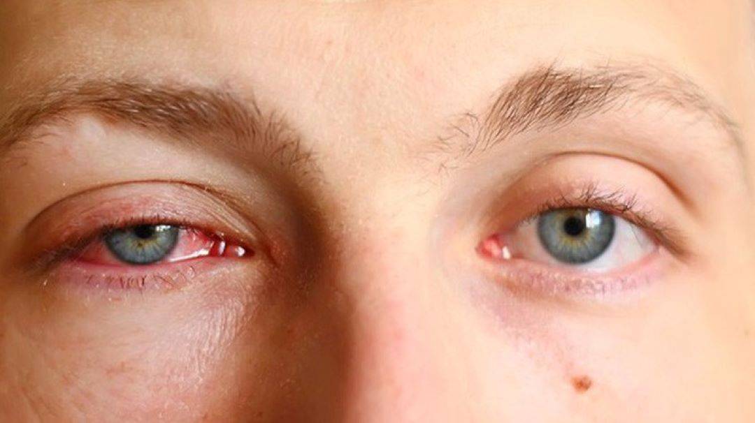 Tiêm filler hỏng khiến vùng mắt bị đau, sưng và rát