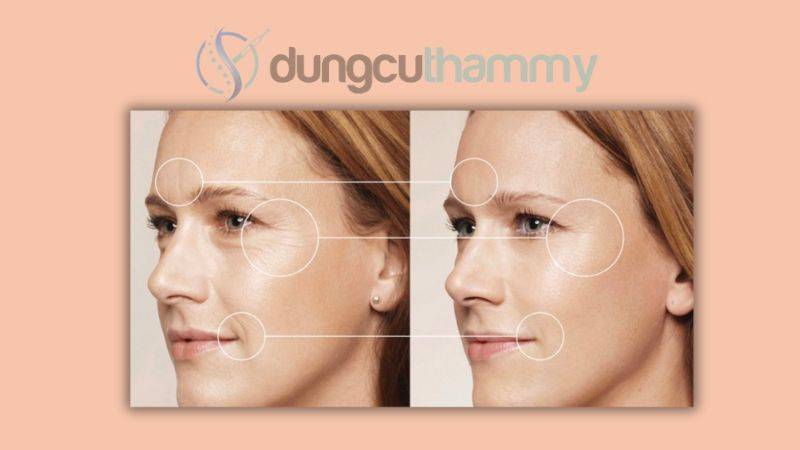 Xác định liều lượng botox cần tiêm